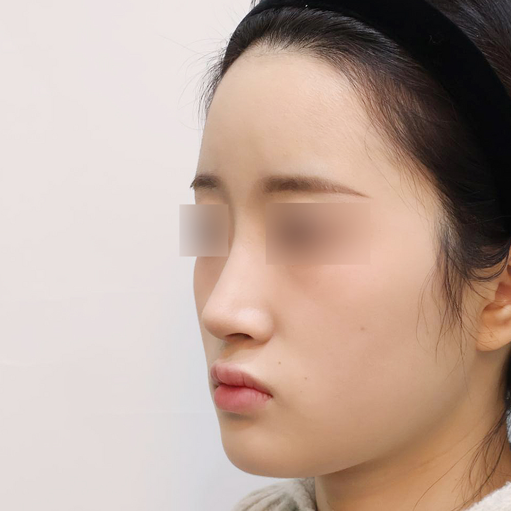 코 수술유형별 후사진