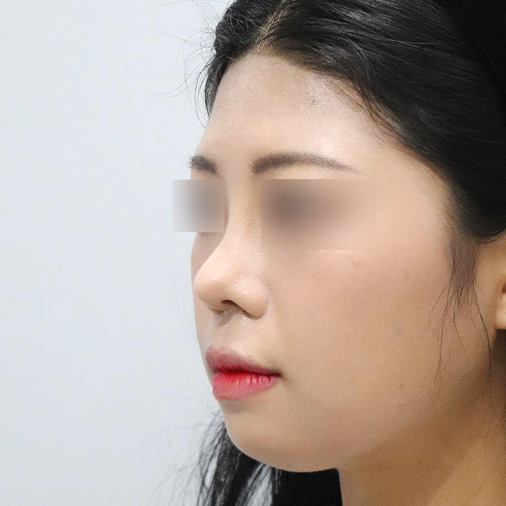 코 수술유형별 후사진