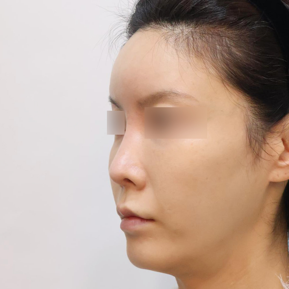 코 수술유형별 후사진