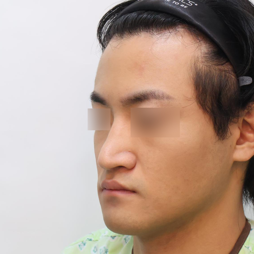 코 수술유형별 전사진