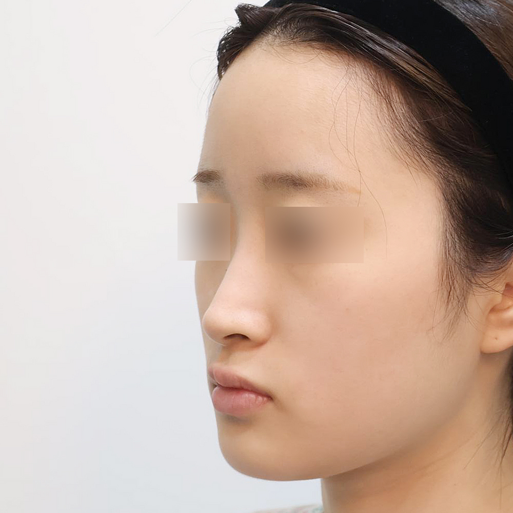 코 수술유형별 전사진