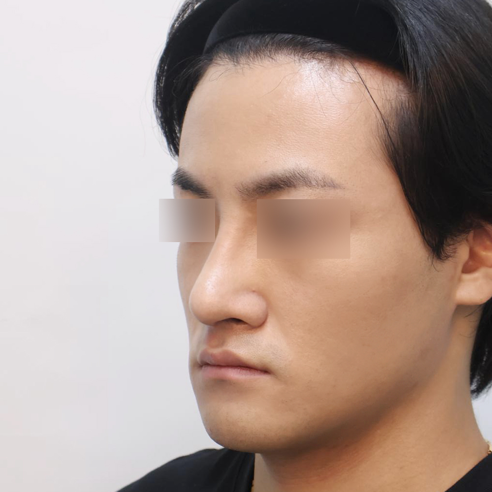 코 수술유형별 후사진