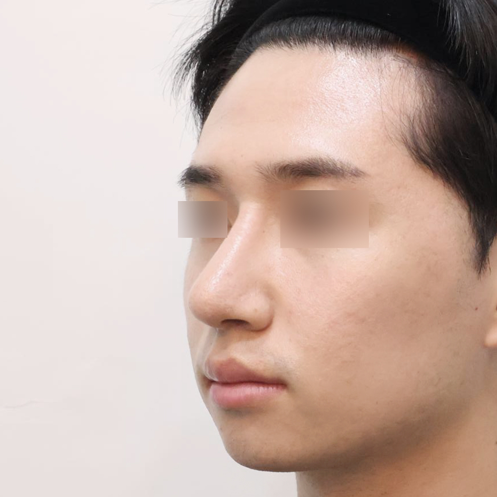 코 수술유형별 후사진