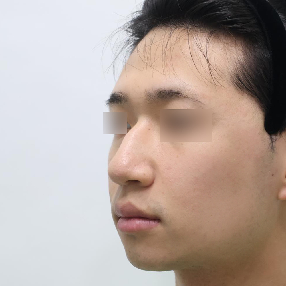 코 수술유형별 전사진