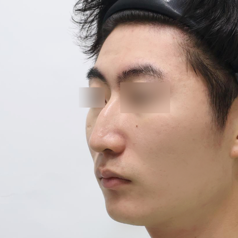 코 수술유형별 전사진
