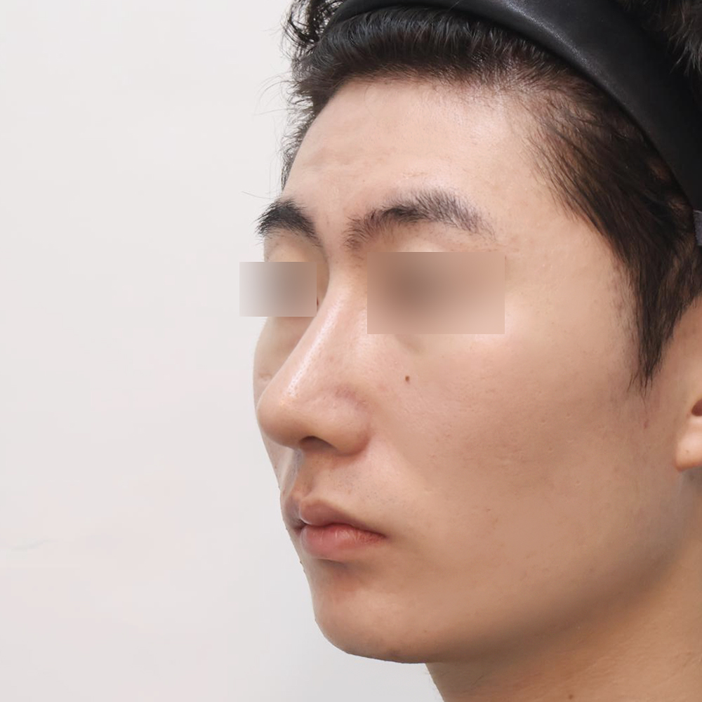 코 수술유형별 후사진