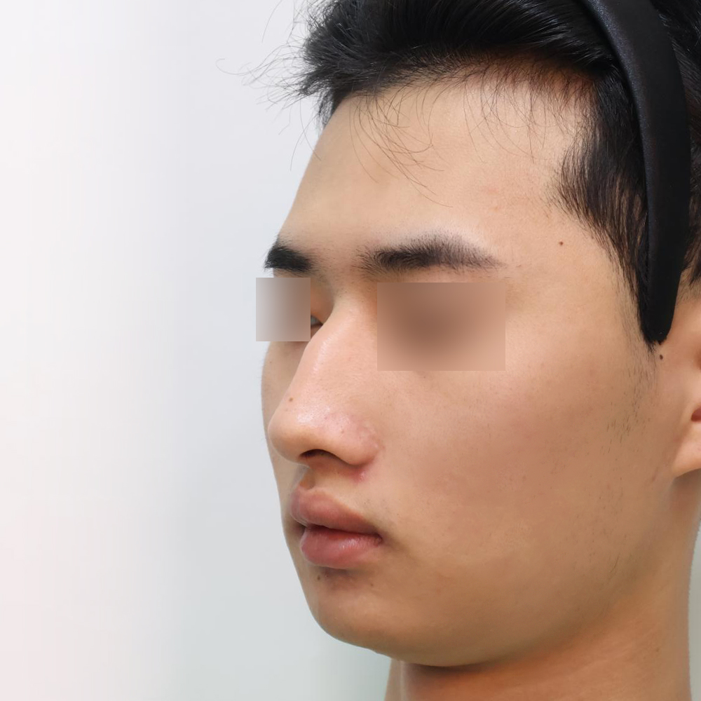 코 수술유형별 전사진