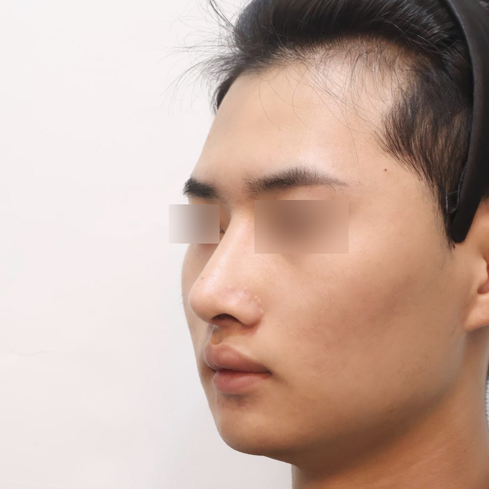 코 수술유형별 후사진