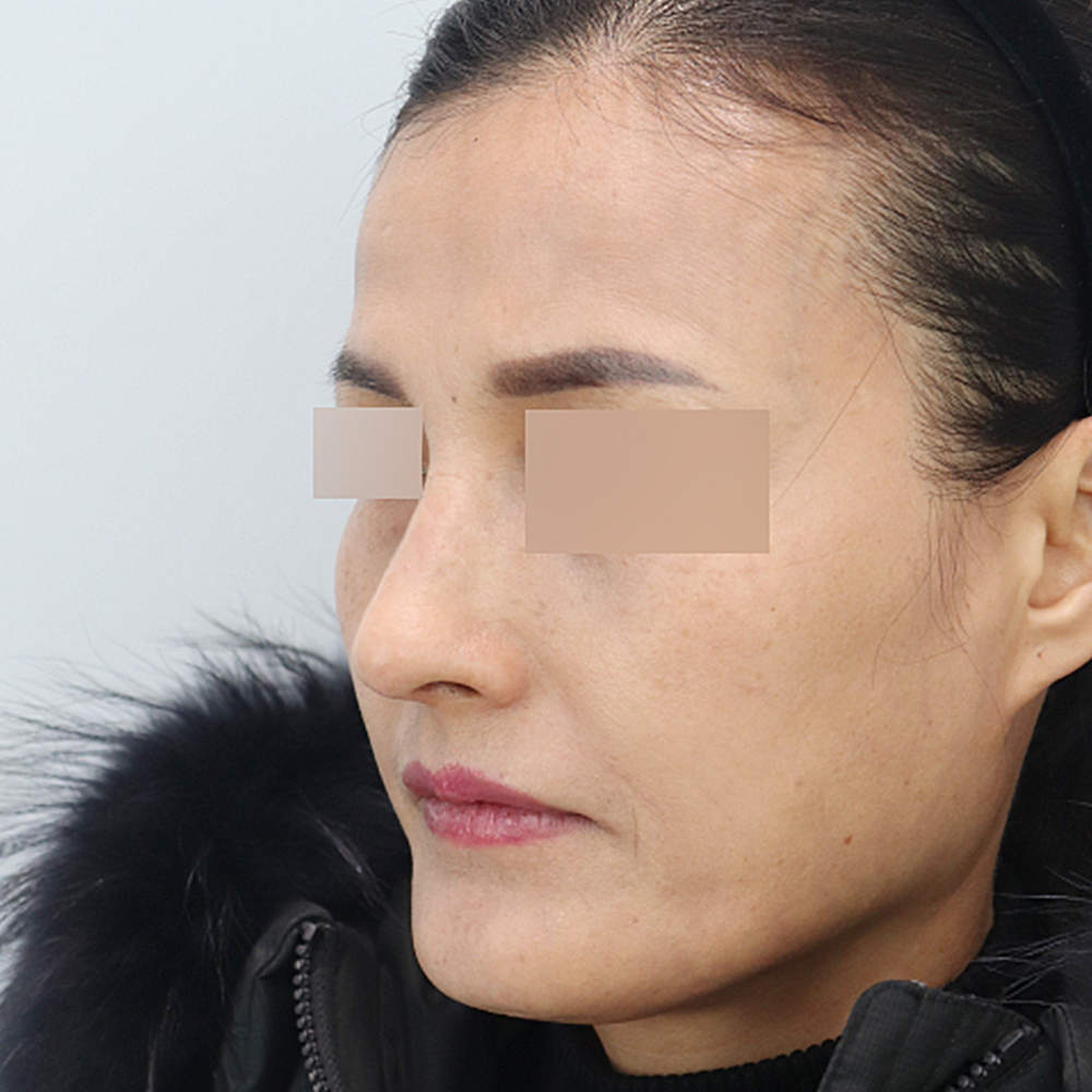 코 수술유형별 후사진