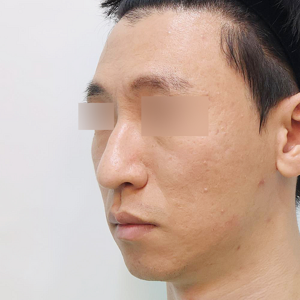 코 수술유형별 전사진