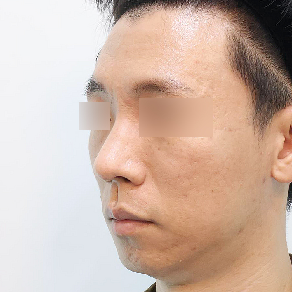 코 수술유형별 후사진